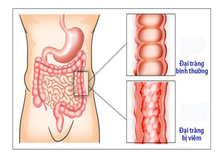 Bệnh viêm đại tràng - Những dấu hiệu &amp; cách điều trị đúng